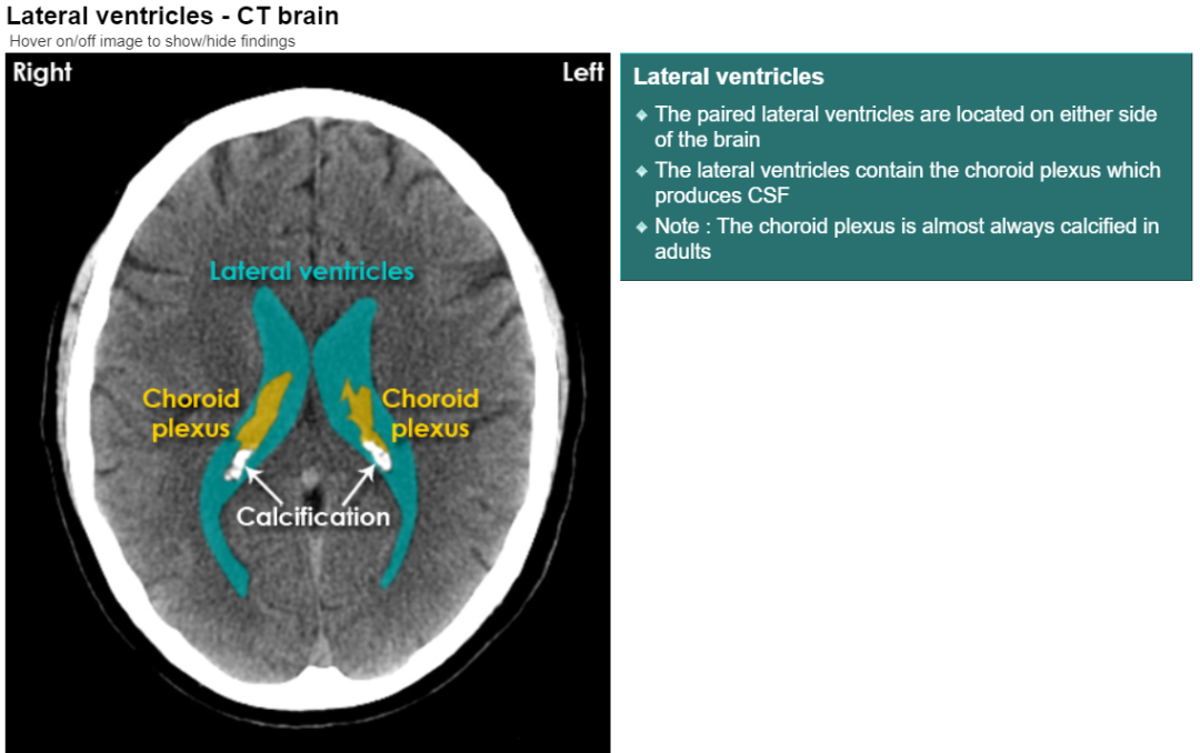 侧脑室三角区CT解剖图图片