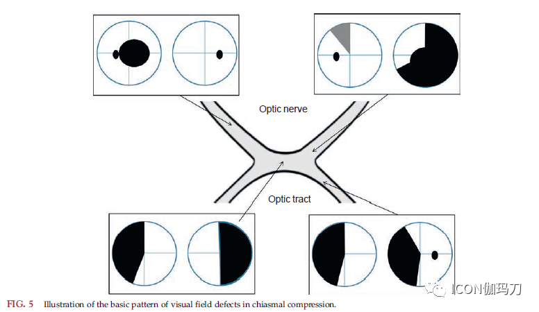 视野缺损图解图片