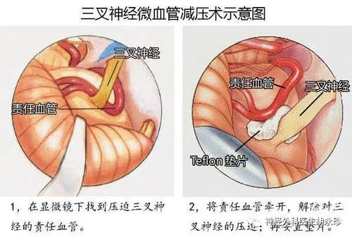 原发性三叉神经痛的治疗