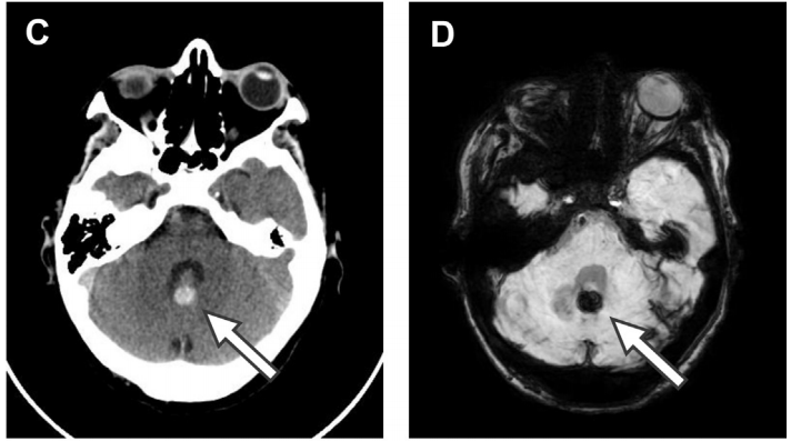 (a) 头部 ct 显示左侧小脑半球和蚓部亚急性梗死,周围细胞毒性水肿