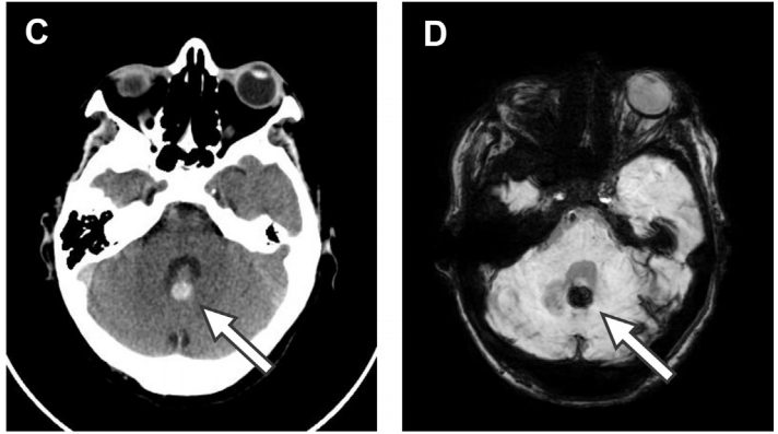 a  头部 ct 显示左侧小脑半球和蚓部亚急性梗死