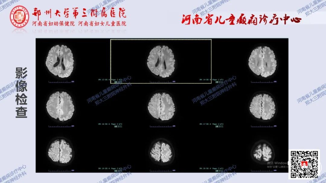 术战癫峰第57期左侧巨脑回畸形行大脑半球离断术一例