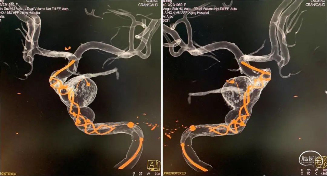 时全星教授:tubridge03治疗颈内动脉c3-c4段多发大动脉瘤一例