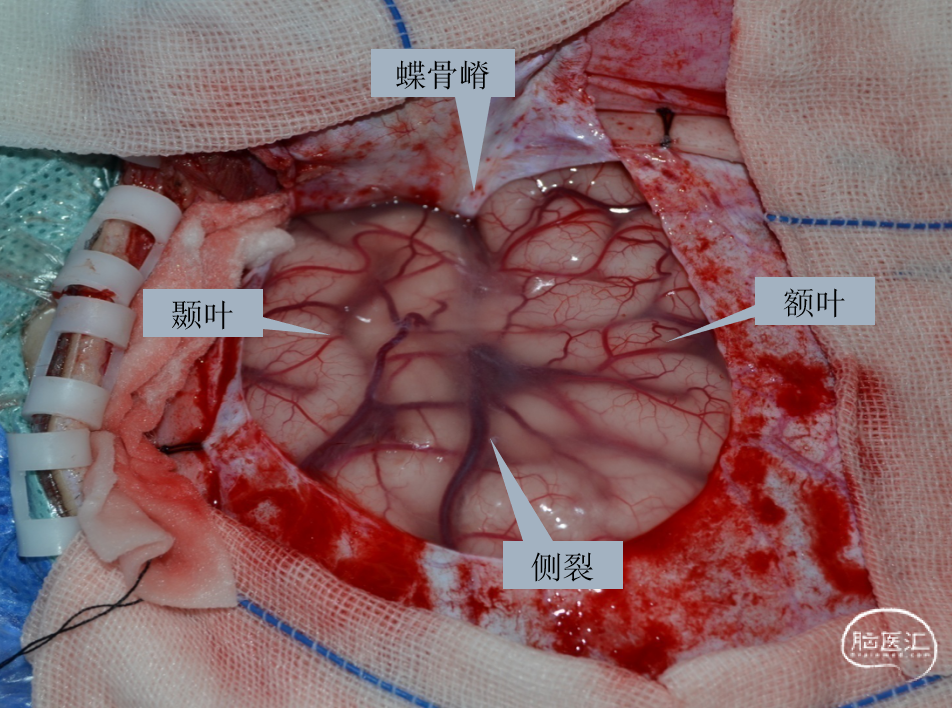 癫痫的外科手术从大脑半球切除到大脑半球切开