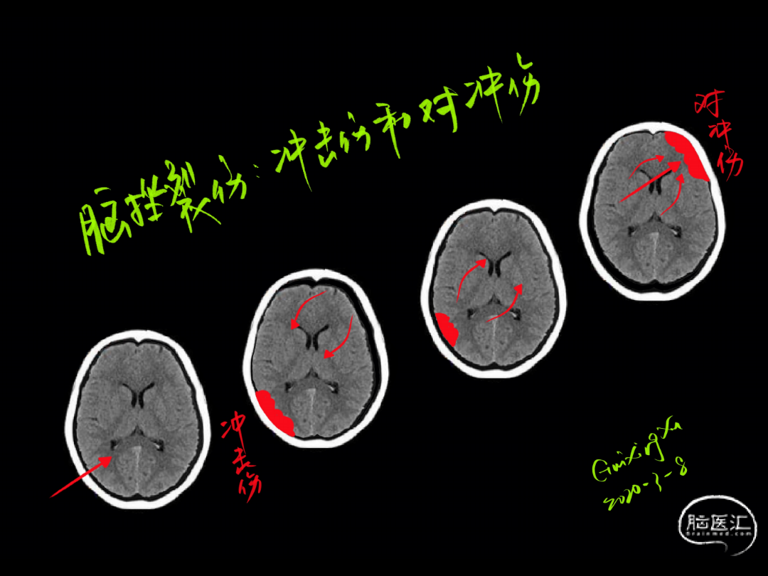 急診頭顱ct徵象手繪