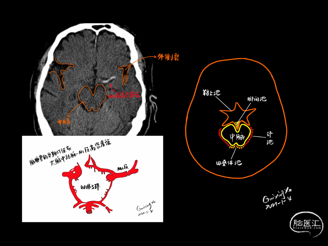 急診頭顱ct徵象手繪