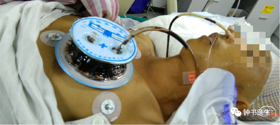 胃肠减压发现咖啡样胃液,考虑应激性消化道出血.