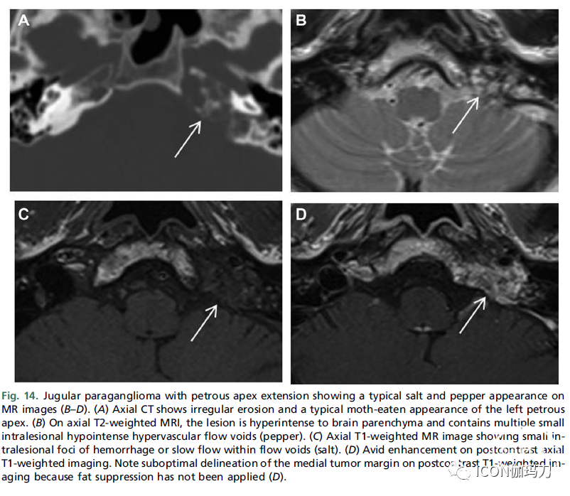 頸靜脈副神經節瘤伴巖尖延伸,mr表現為典型的鹽和胡椒樣表現(b-d).