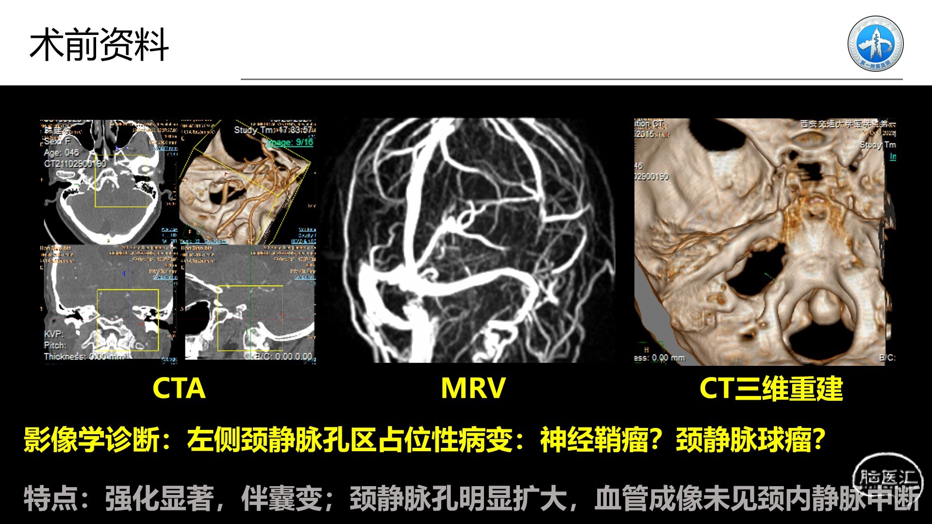 西安交通大學第一附屬醫院王拓教授團隊一例頸靜脈孔區神經鞘瘤切除術