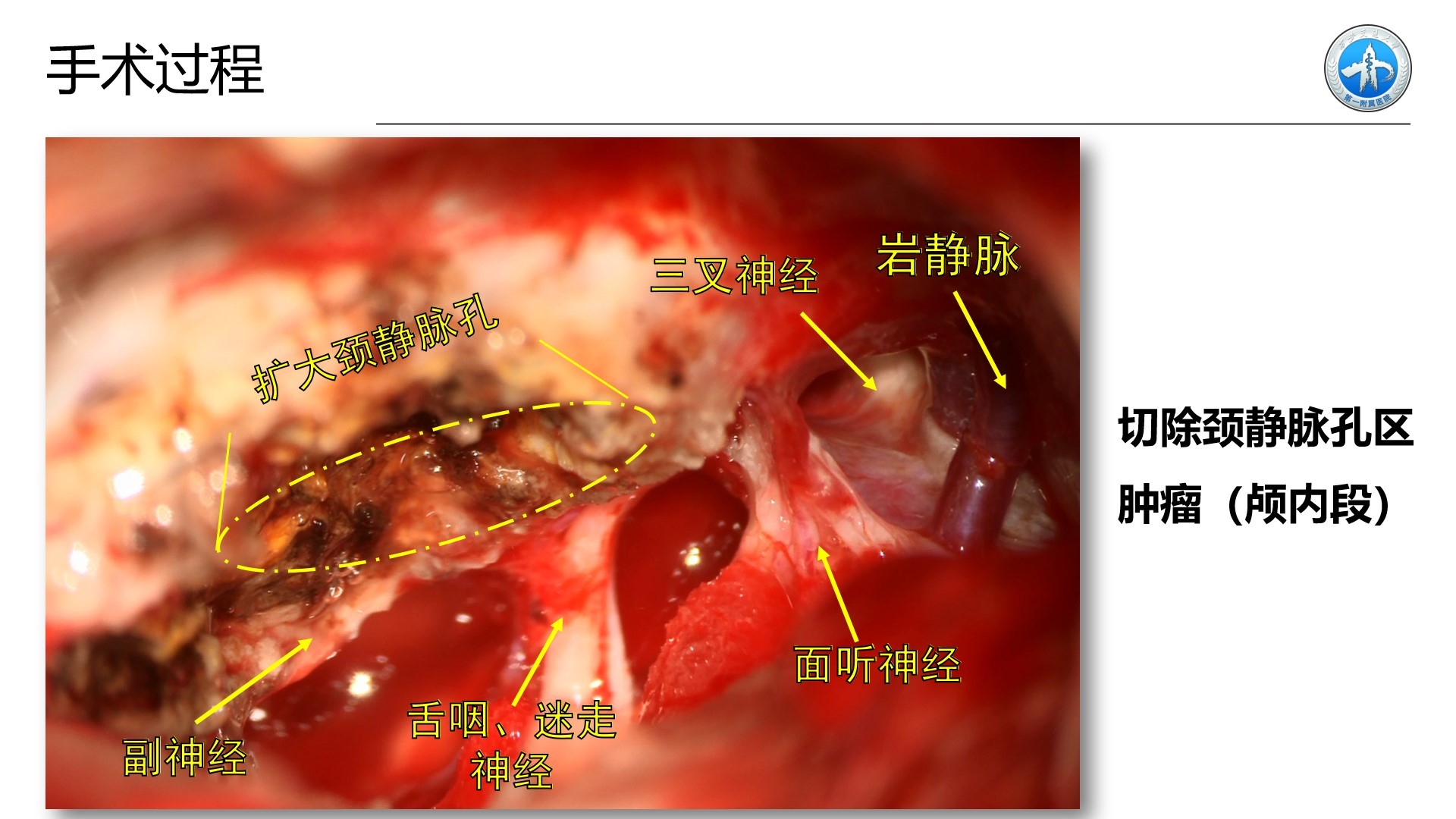 西安交通大學第一附屬醫院王拓教授團隊一例頸靜脈孔區神經鞘瘤切除術