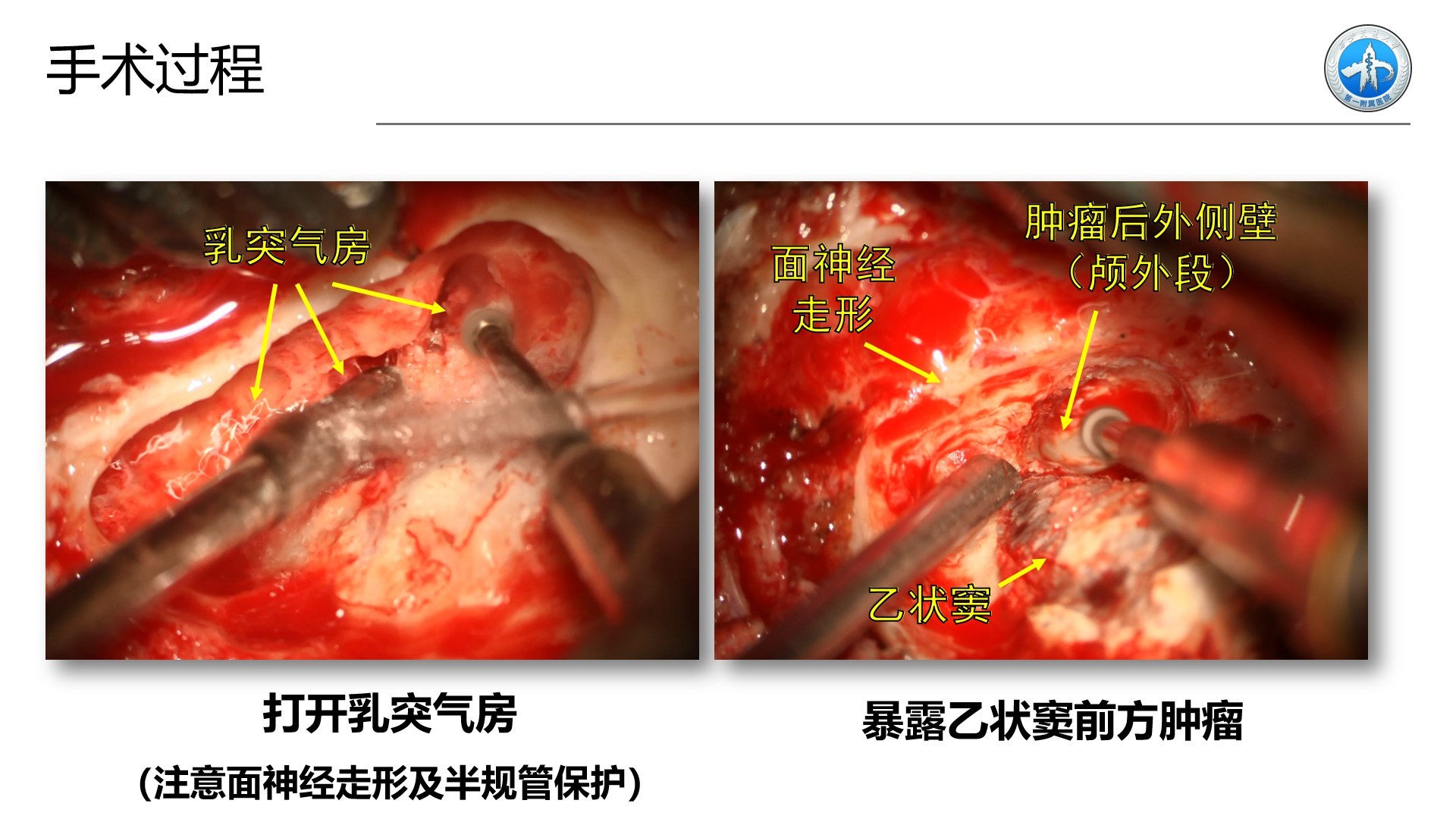 西安交通大學第一附屬醫院王拓教授團隊一例頸靜脈孔區神經鞘瘤切除術