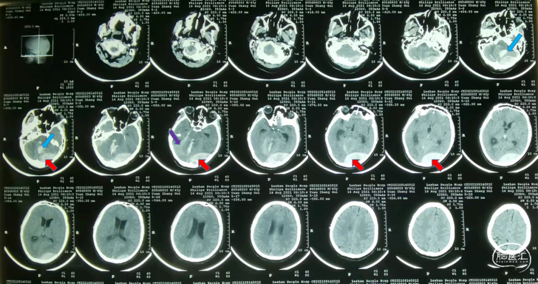 監測有道丨一例跨橫竇巨大硬膜外血腫伴小腦血腫的救治體會顱腦創傷