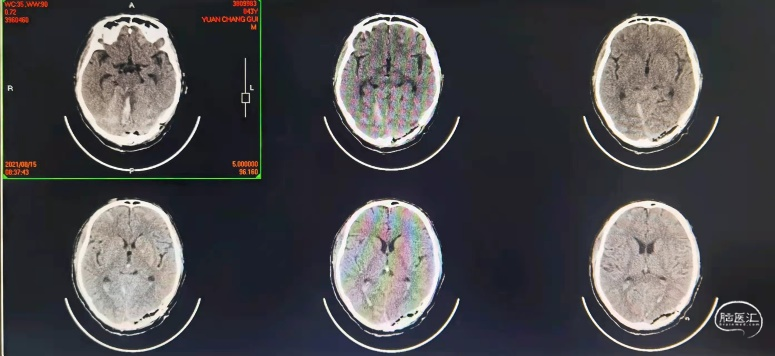 監測有道丨一例跨橫竇巨大硬膜外血腫伴小腦血腫的救治體會顱腦創傷