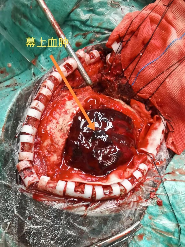 硬膜外血图片