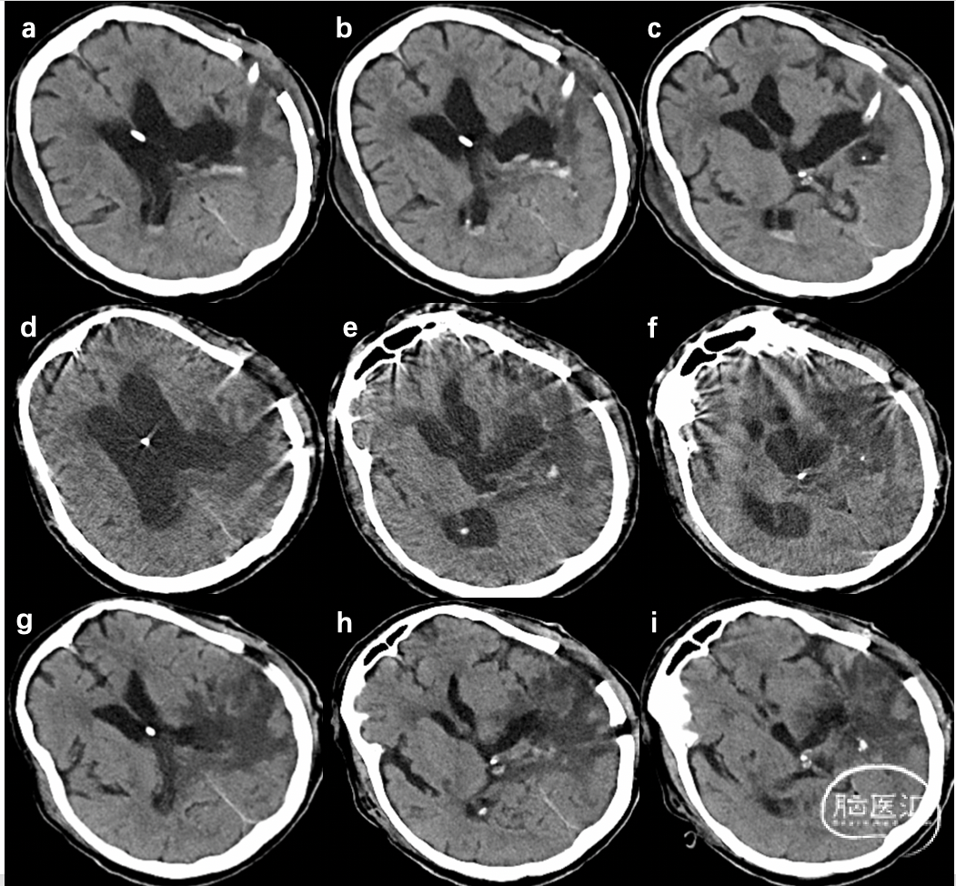 CT38150:一例脑积水病人，没有临床症状，请大家会诊 - CT病例讨论 医影在线