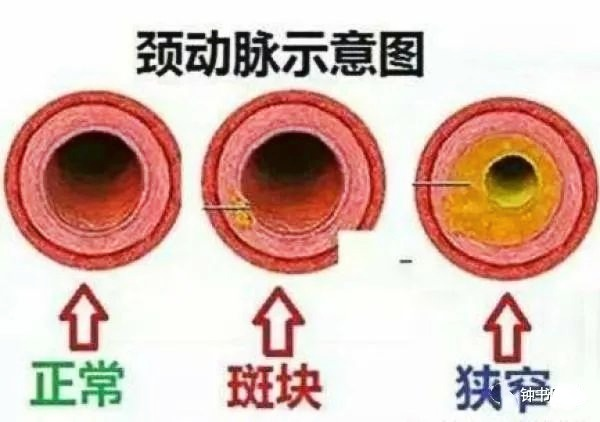 脑血管中度狭窄图片