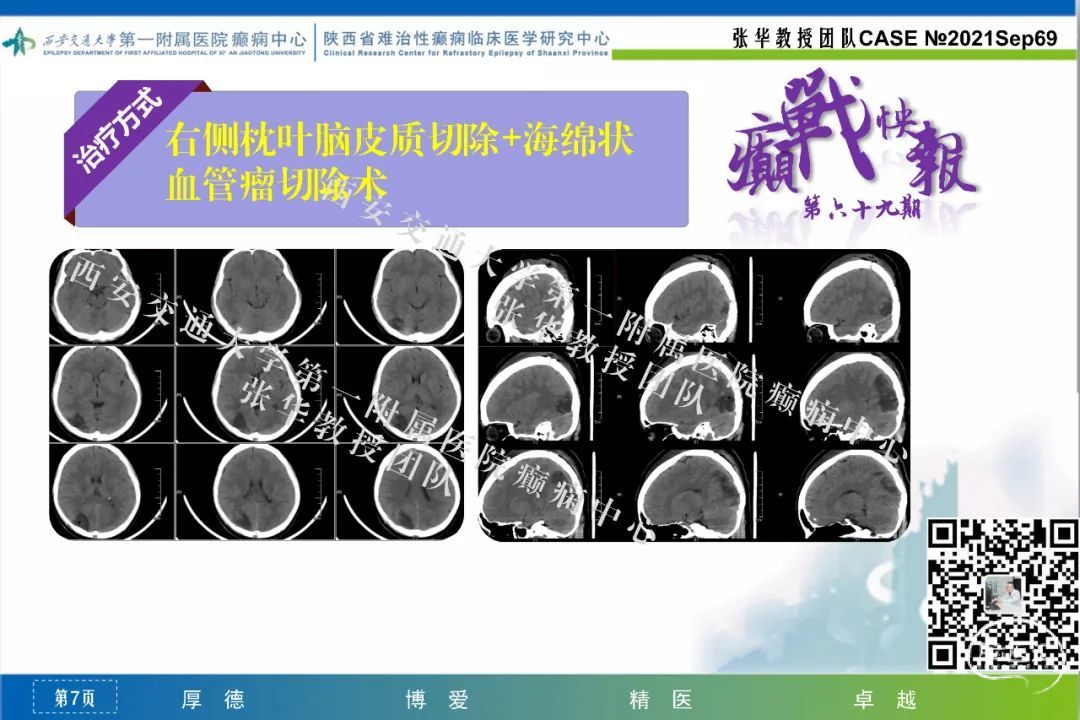 癲戰快報第69期枕葉皮質發育異常合併海綿狀血管瘤繼發癲癇一例