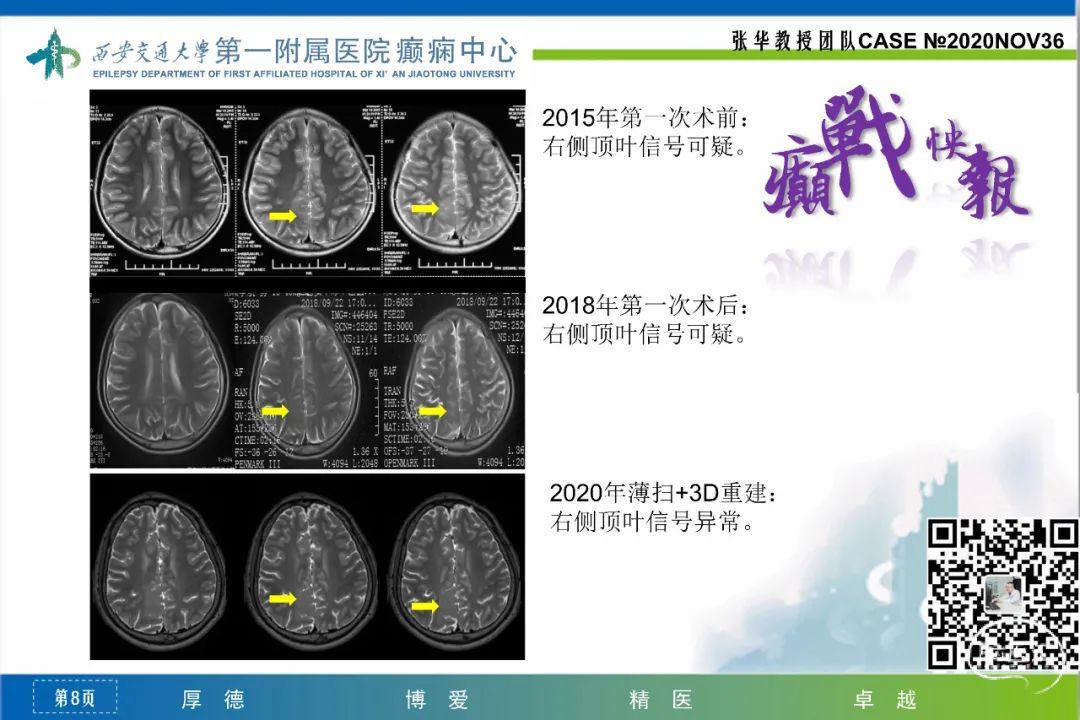 癲戰快報第36期胼胝體切開術後右頂葉癲癇病灶切除術1例