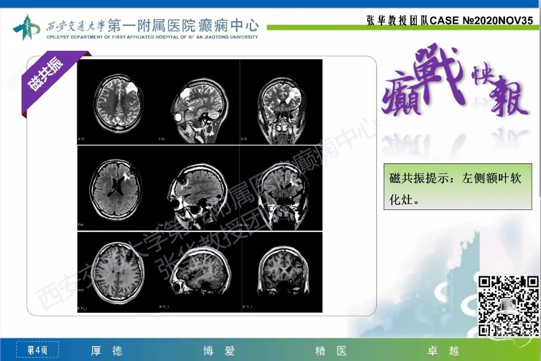 【癲戰快報】第35期:左側額葉外傷繼發癲癇一例