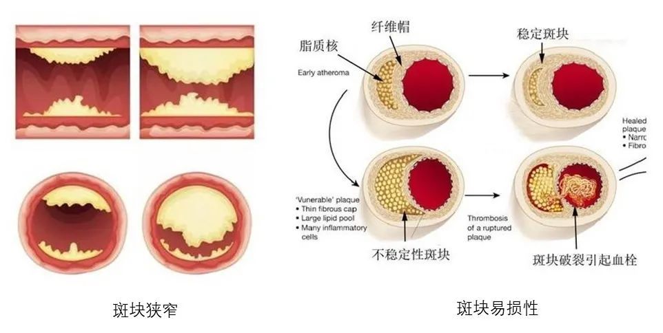 血管斑块,就是血管上的水垢.