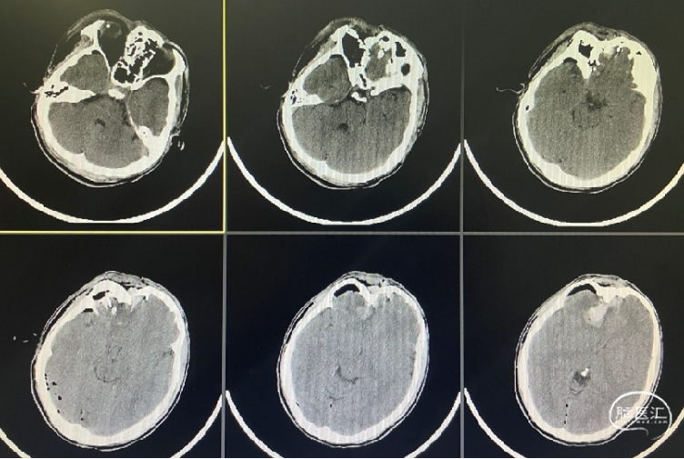 监测有道丨开放性颅脑外伤伴前额部粉碎性骨折一例报道颅脑创伤神经