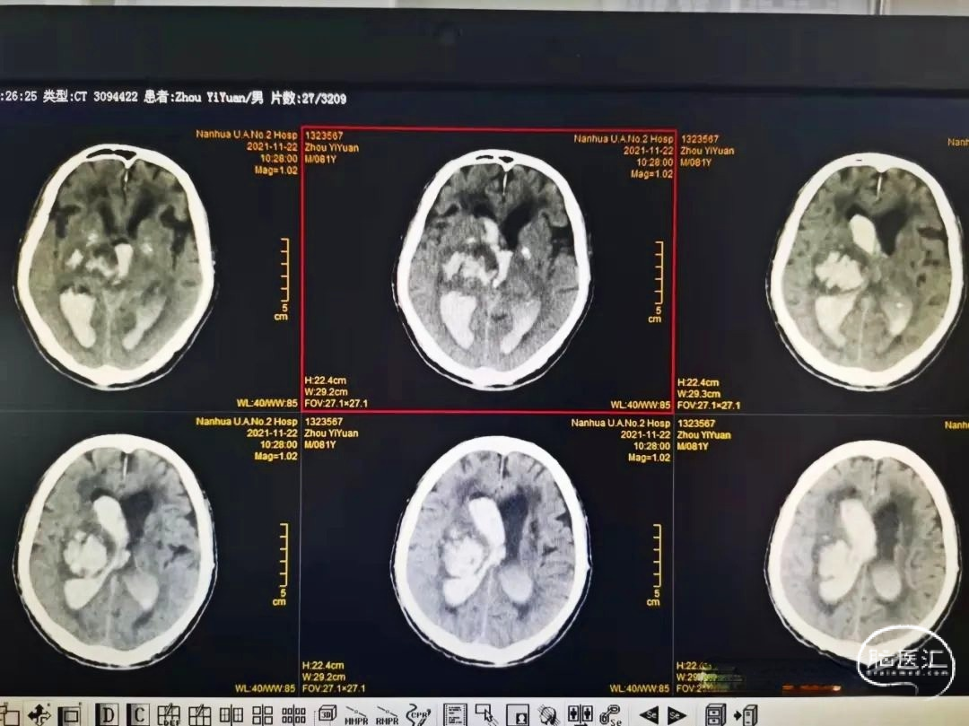 6 个病例学会「脑梗死」的 4 大 CT 征象_动脉