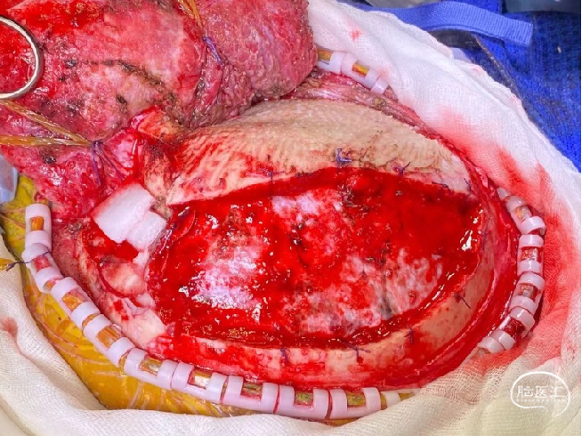 监测有道丨开放性颅脑外伤伴前额部粉碎性骨折一例报道颅脑创伤神经