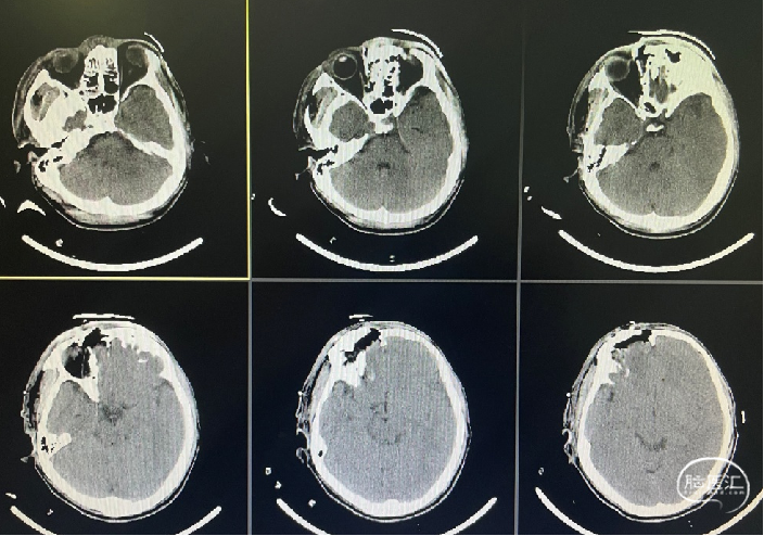 監測有道丨開放性顱腦外傷伴前額部粉碎性骨折一例報道顱腦創傷神經