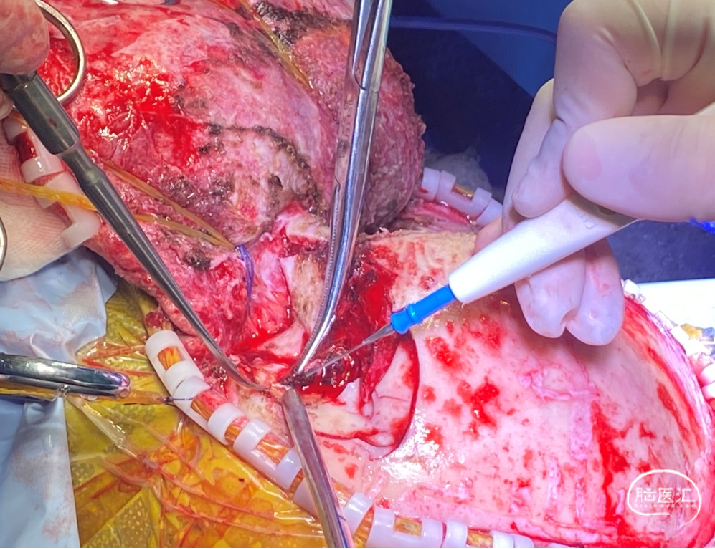 清除伤口异物,彻底清创消毒,双氧水,洗必泰反复冲洗.