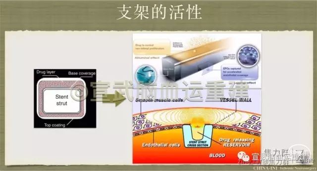我所认识的颈动脉支架（2） - 脑医汇