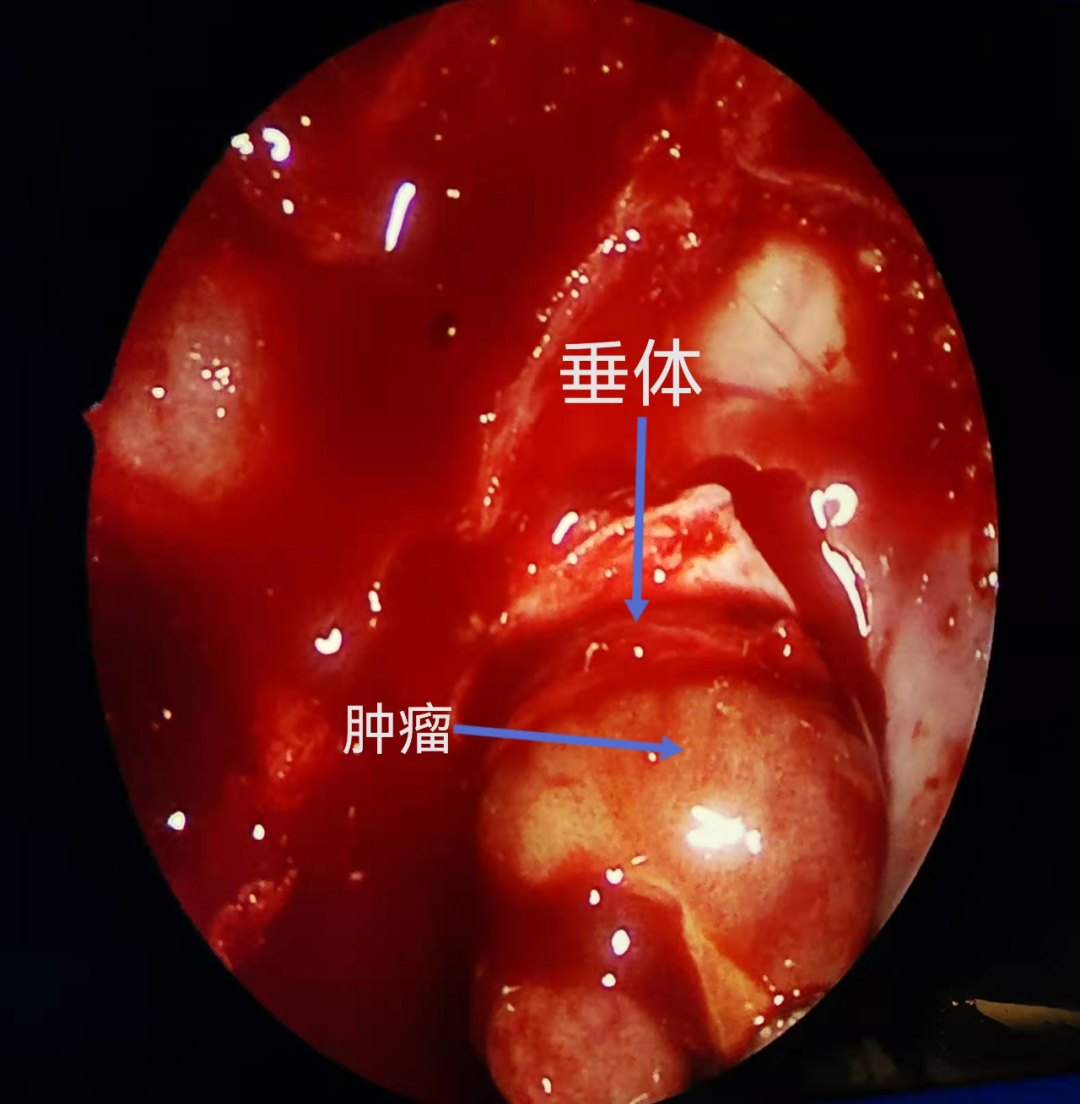 内镜经鼻切除垂体瘤相关技术小结游学意大利十三