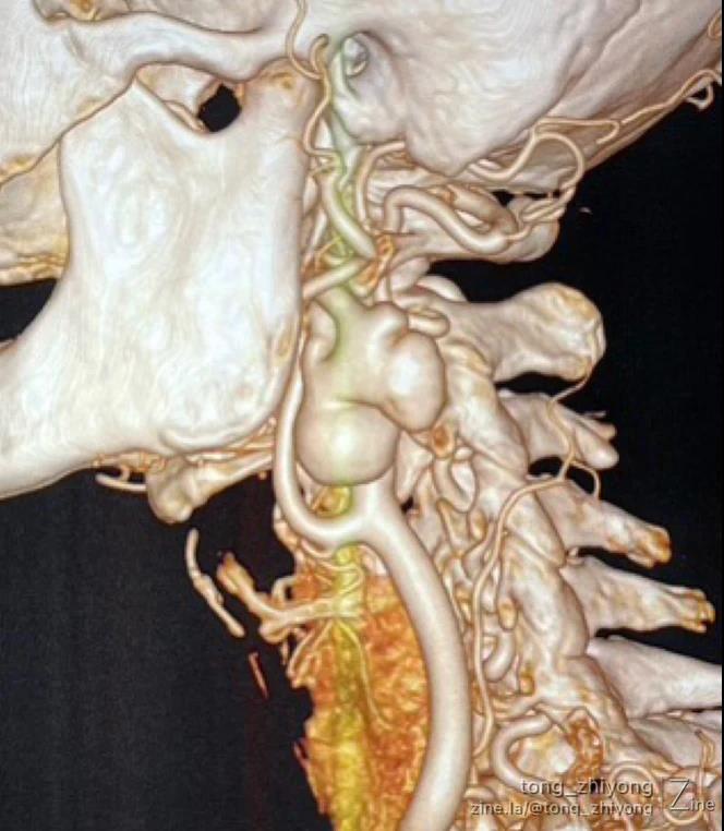 颈动脉瘤位置图片图片