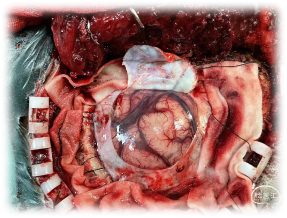 数字医学在脑出血的手术应用一例