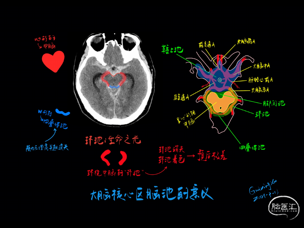急診頭顱ct徵象手繪3