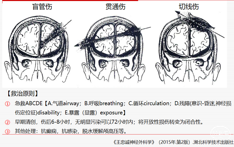 开放性颅脑损伤的救治