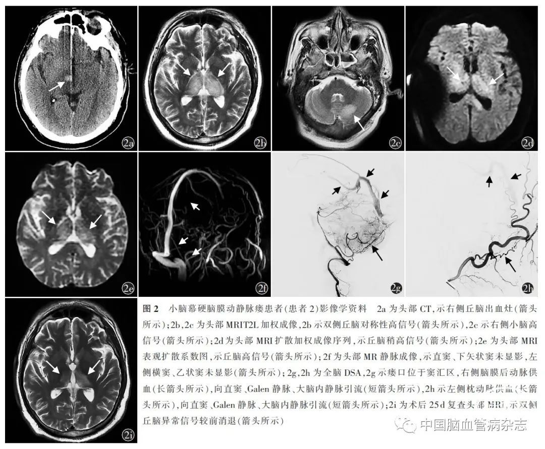 病例報告小腦幕硬腦膜動靜脈瘻三例臨床分析