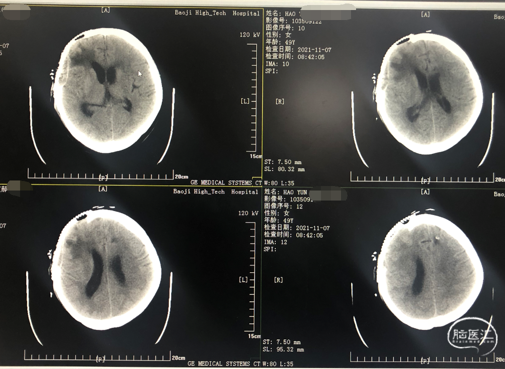 非常规部位脑内血肿脑动脉瘤诊治回顾