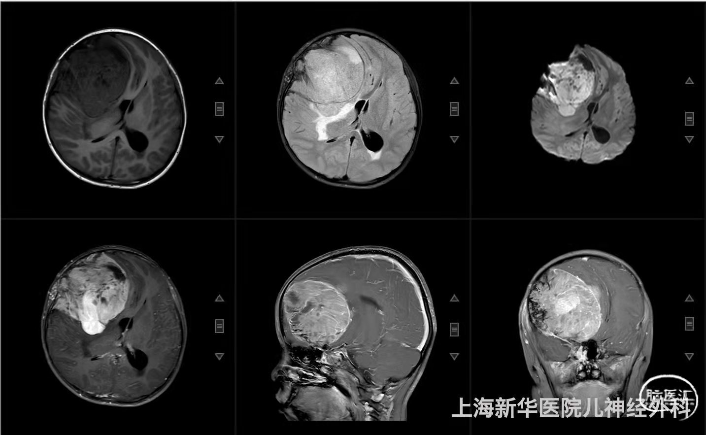 兒童原發顱內尤文肉瘤1例(點擊標題閱讀全文)作者:馬傑 王保成 茅