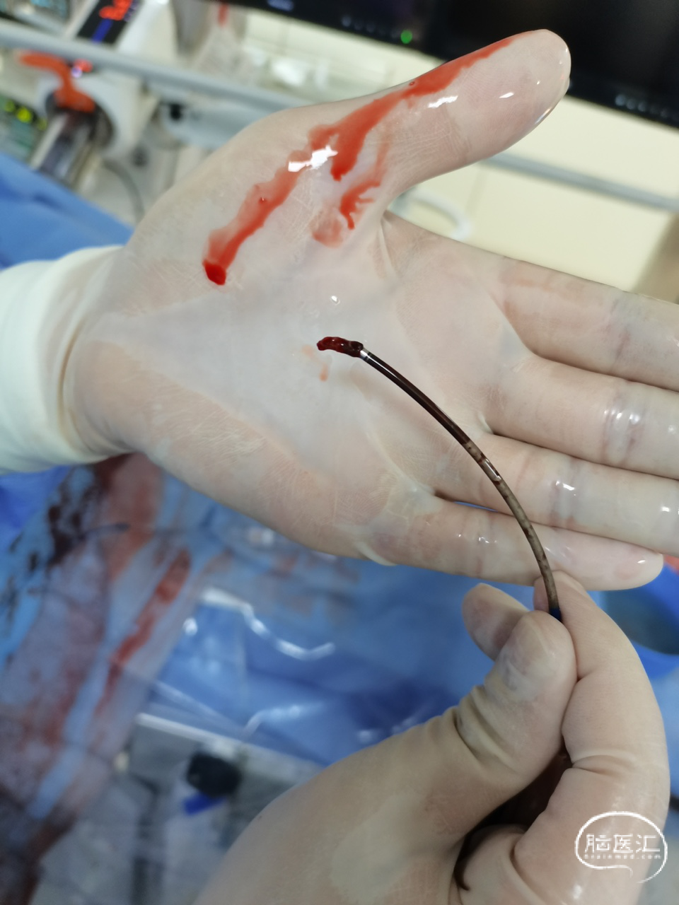 血栓抽出068 skathi远端通路导管 抽吸后造影cat6导管抽吸,但抽吸失败