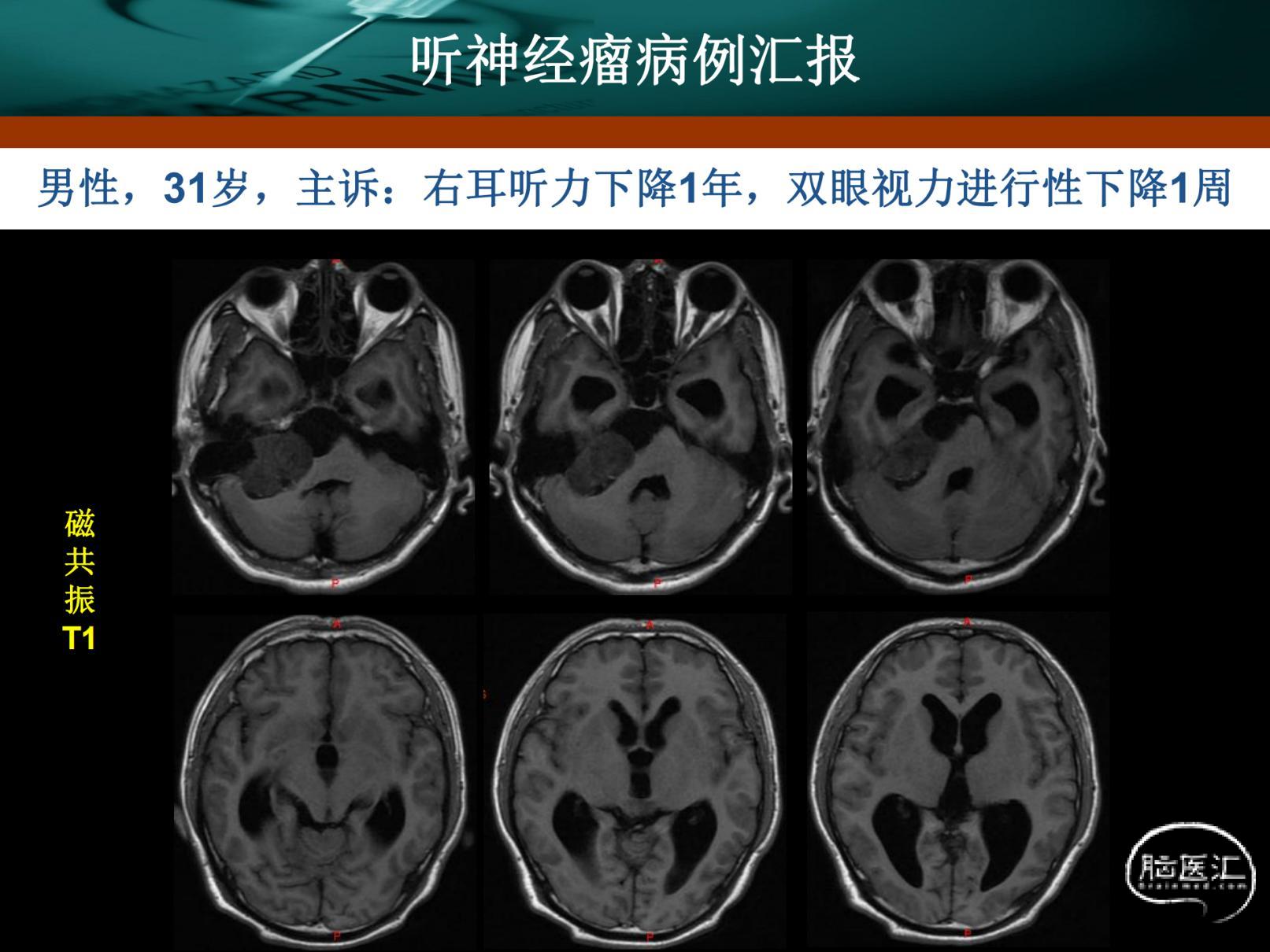 贺晓生教授右桥小脑角听神经瘤切除案例_手术