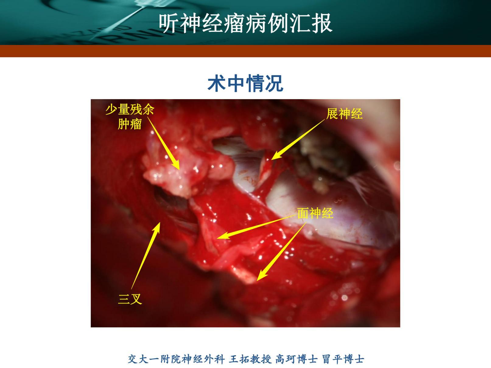 刘振听神经瘤_20220117121053_纯图版_10.jpg