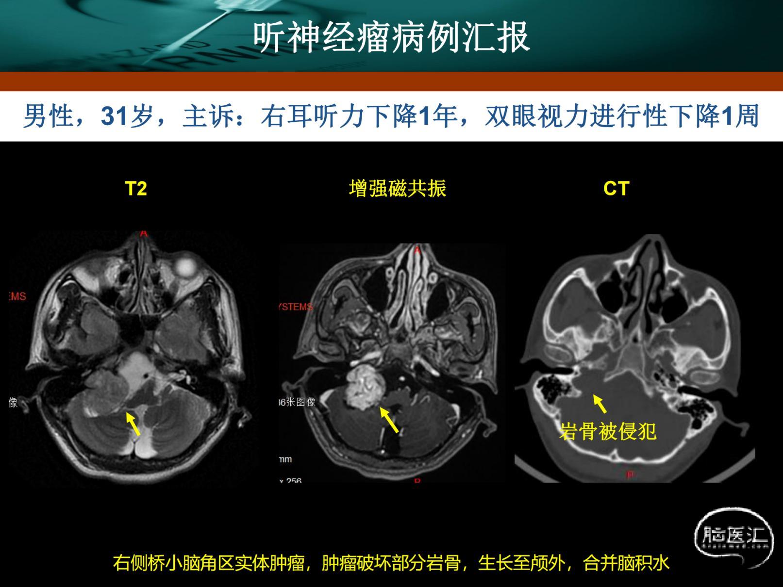 刘振听神经瘤_20220117121053_纯图版_02.jpg