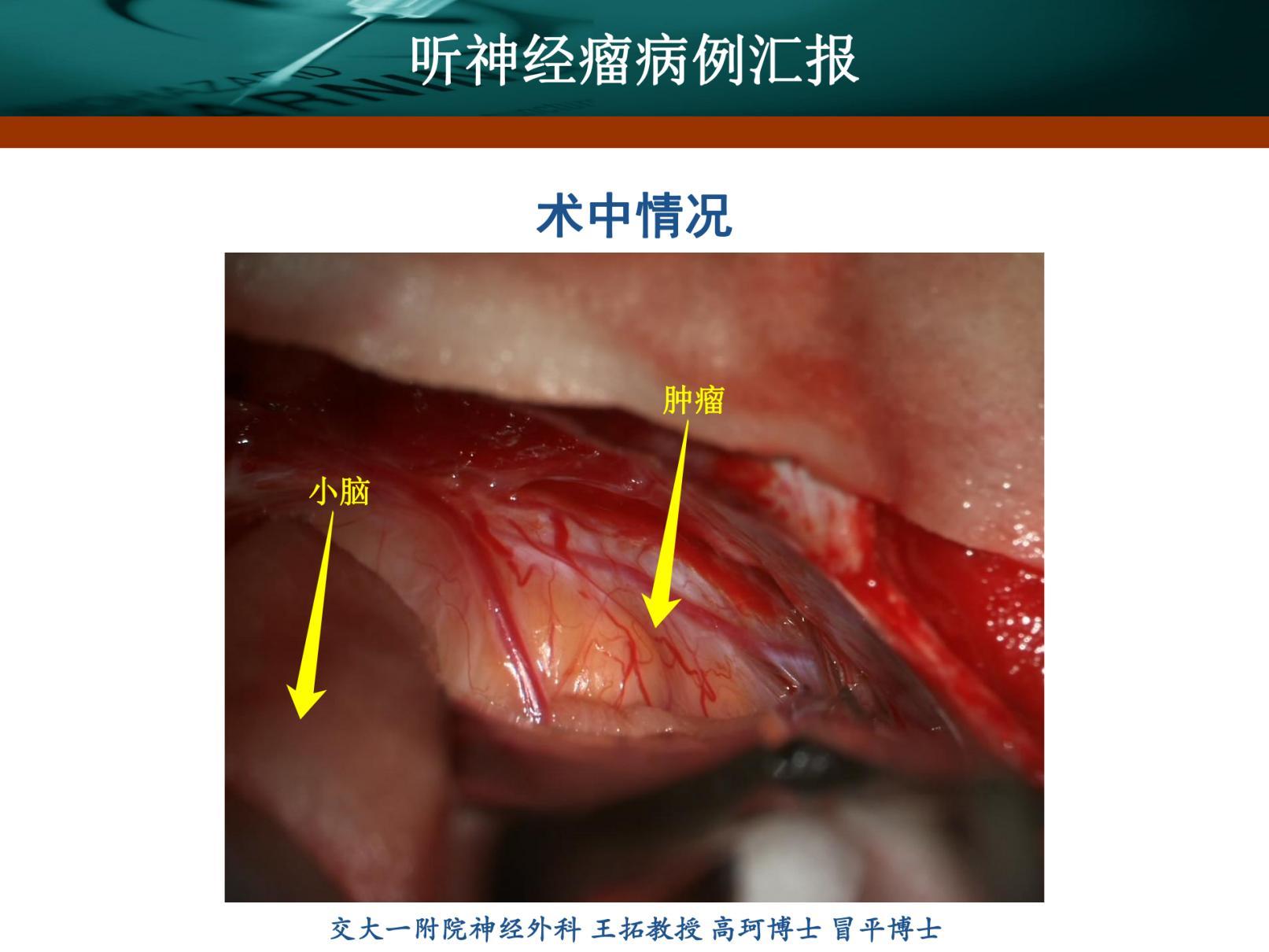 刘振听神经瘤_20220117121053_纯图版_07.jpg