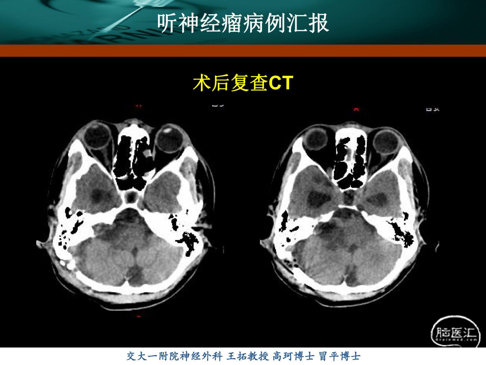 刘振听神经瘤_20220117121053_纯图版_11.jpg