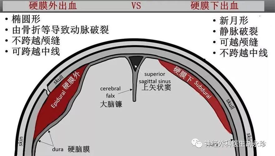 神经内镜手术治疗老年慢性硬膜下血肿