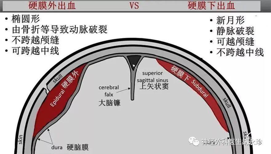 慢性硬膜下血腫的患者絕大多數都有輕微頭部外傷史,尤以老年人額前或