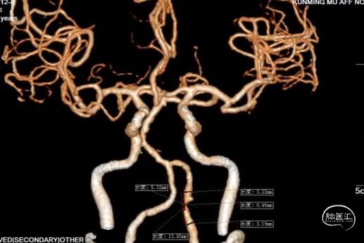 nova顱內藥物球擴支架在左側椎動脈v4段重度狹窄中的應用昆明醫科大學