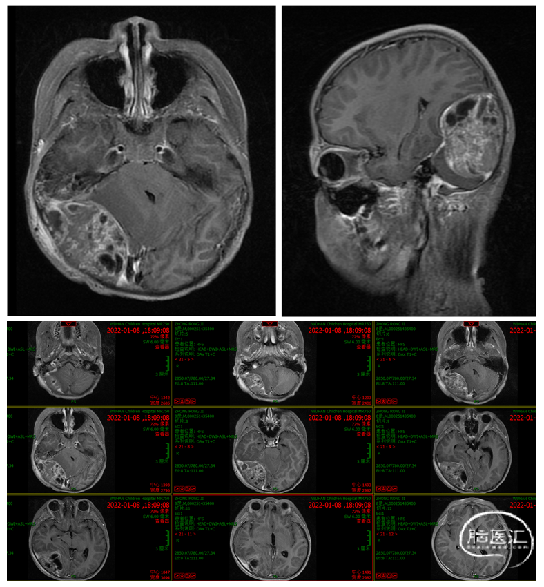 图1.术前磁共振增强.png