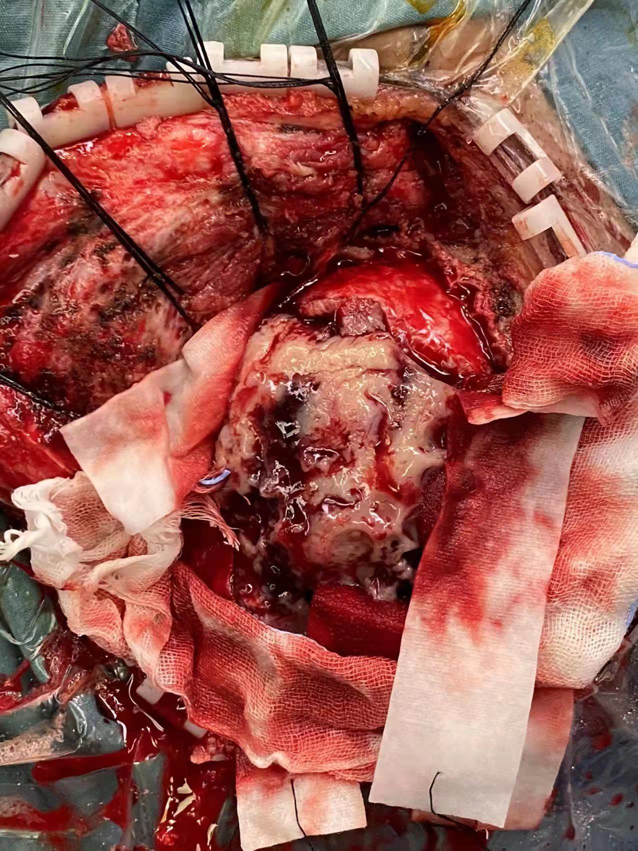 武汉儿童医院神经外科儿童颅内尤文肉瘤病历分享