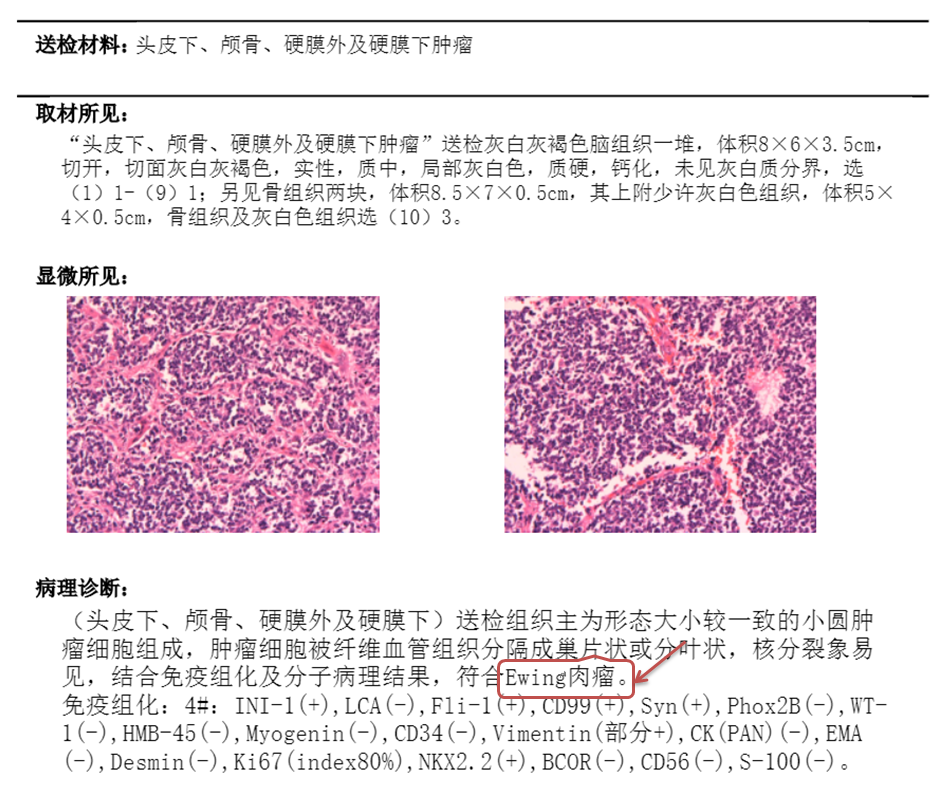 尤文肉瘤病理图片图片